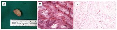 Aggressive Angiomyxoma in the Scrotum: A Case Series and Literature Review